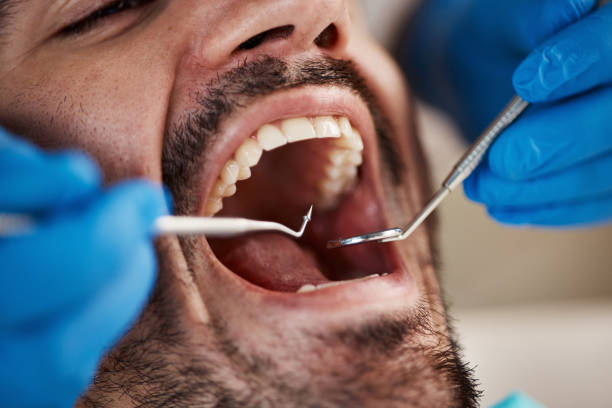 Best Cracked Tooth Emergency Dentist  in South San Jose Hills, CA